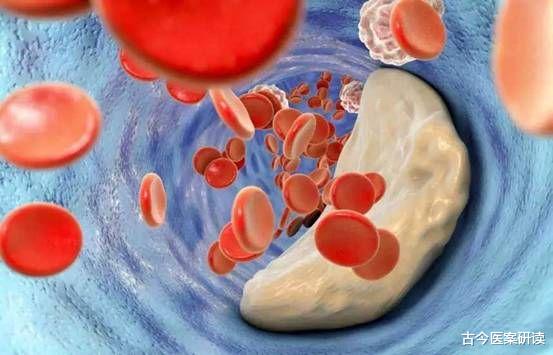 医生|42岁男子血管长满“水垢”！医生：常吃3物，血管或能“光滑如玉”