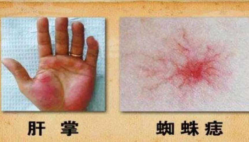 医学传声筒|肝病科医生提醒：想要远离肝病，坚持做好3件事，肝强壮健康