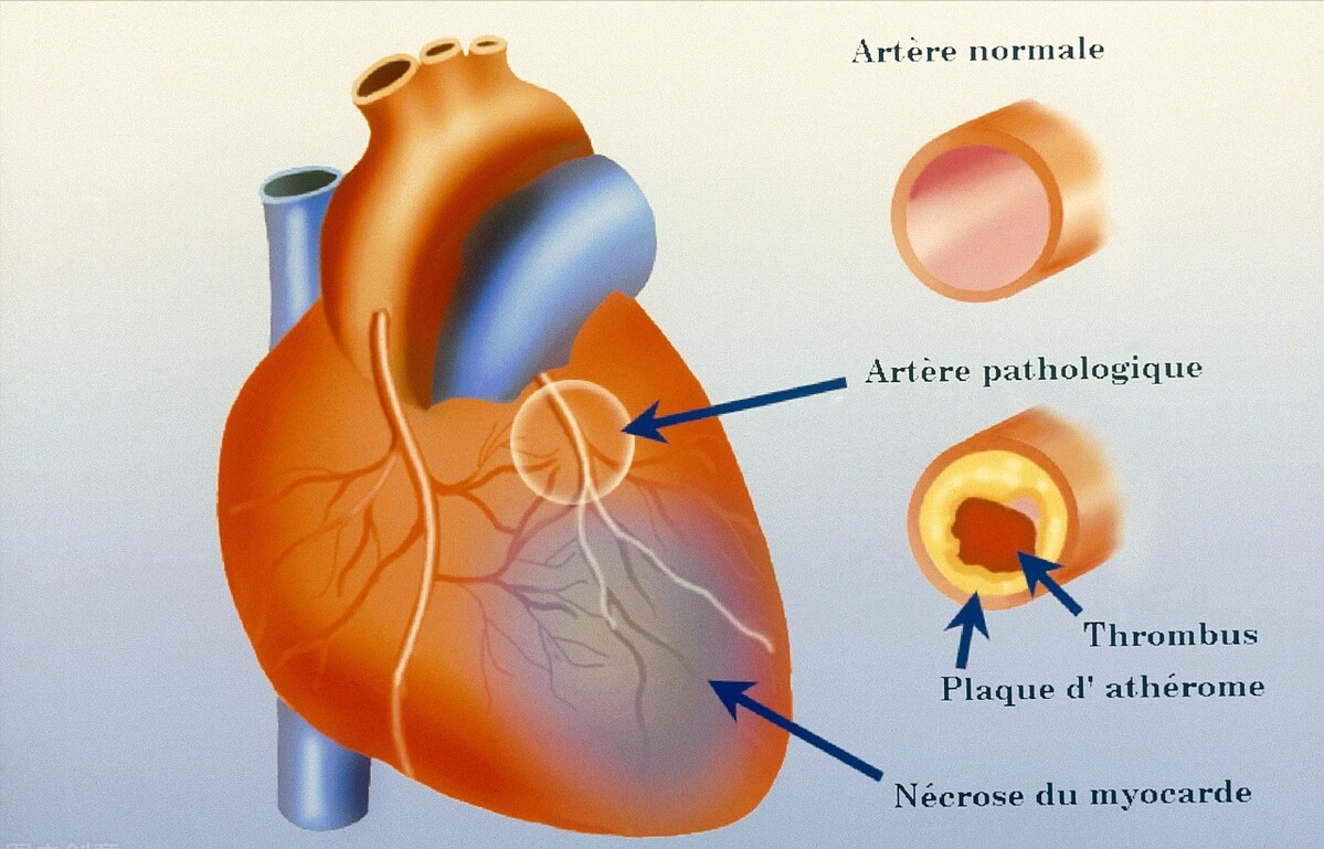 中成药|3个中成药，为血管做次“大扫除”，改善瘀阻打通经络，心脑同治