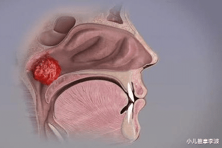 小儿推拿李波|小儿推拿李波：为何孩子割了腺样体却还是流鼻涕、鼻塞、打鼾呢？