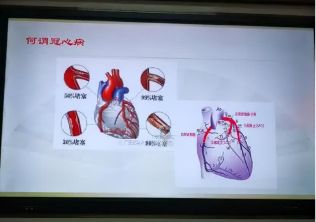 午美聊健康体态 血管“堵”了，心梗、脑中风、猝死来敲门？用5招拯救血管