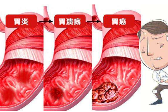 小思医生|胃病的“帮手”找到了，医生：不想胃“烂如渔网”，3种食物要少吃