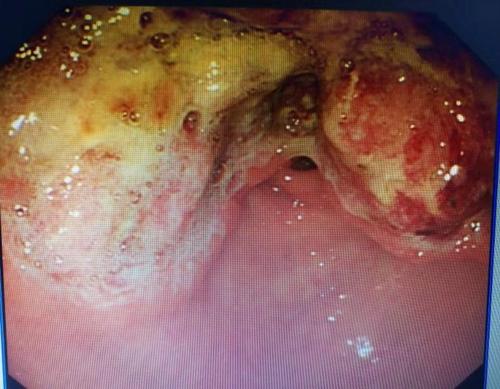 医生|青年从确诊胃癌到去世，只用了7天，医生：真正病因比胃癌还凶猛