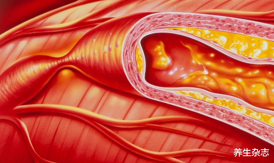 美好大千世界|吃炸花生会升高血脂？医生：无知，不想血脂“飙升”，3种下酒菜要少吃