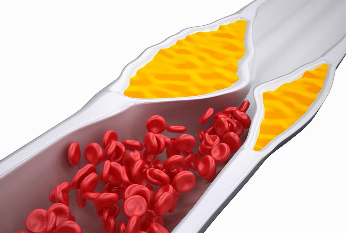 苦瓜|脑梗的“救命药”找到了，不是苦瓜，没事随便吃一点，血管不堵塞