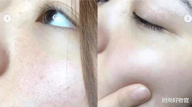 时尚好物官|女子为去皱纹连扎20多针除皱针，竟变成这模样？网友：幸好没跟风