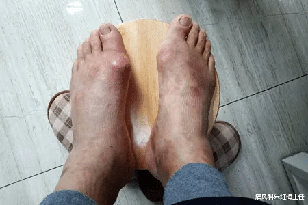 痛风|痛风和肾病,是先有“痛风”还是先有“肾病”?