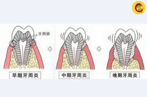 强良之声 洗牙是救牙还是套路?爱牙的你快来看看吧。