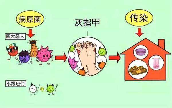 健康养生冲我作|为什么得灰指甲？得了灰指甲怎么治？听医生说