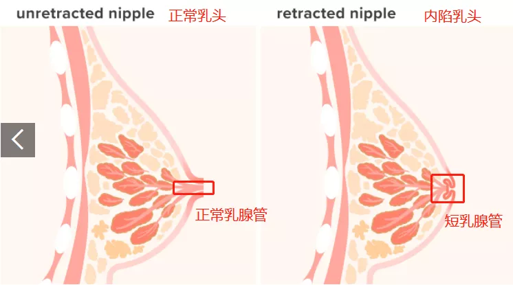 婴幼儿常识|国药育儿知识：女孩子乳头一个变化，年龄越大越当心！