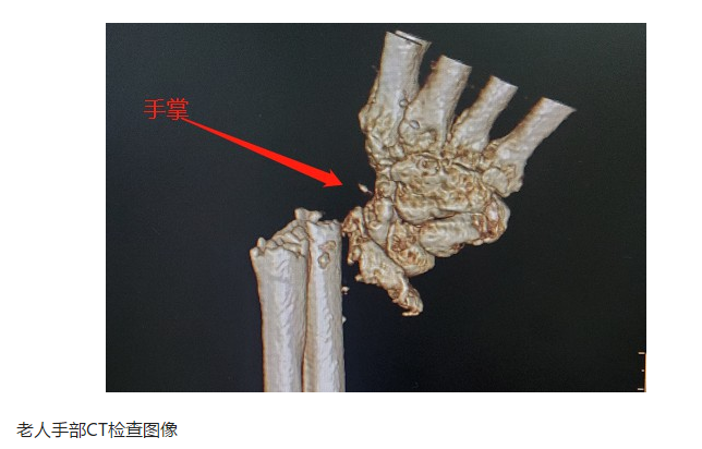 掌上社评 丽水比特犬咬伤77岁老太，事发时犬只未拴绳，也未办理狗证