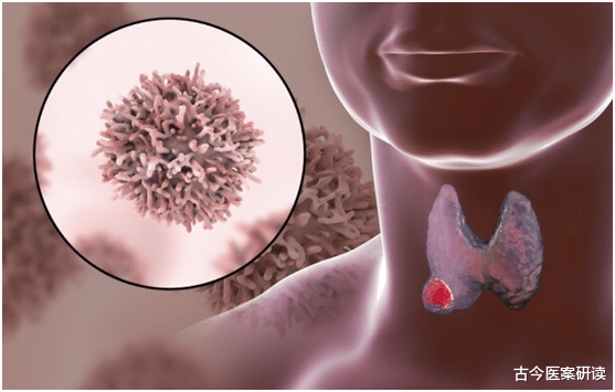 古今医案研读|男子患甲状腺结节，半年恶化，提醒：1零食或是“凶手”，很多男性爱吃