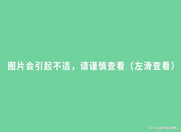 DrKing科学家庭育儿|这种先天性眼病，极易拖成泪囊炎！娃眼屎多是第一征兆！