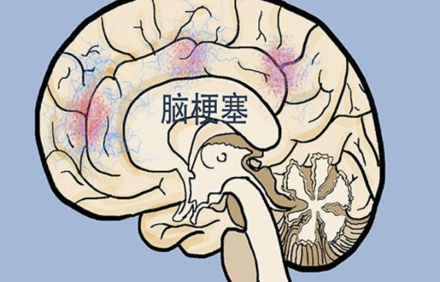 脑梗|年轻情侣相继得脑梗！医生怒斥：睡前常做1件事，血液比油还粘稠！