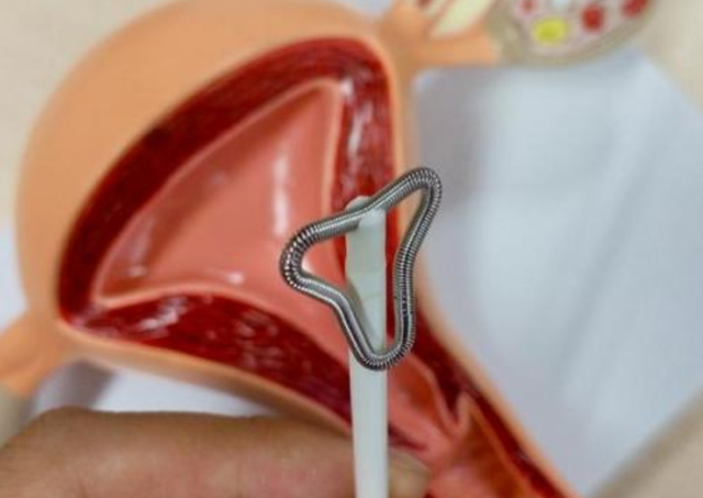 全能辣妈plus|避孕方式千千万,哪个对女性最友好?“结扎”和“上环”别乱选