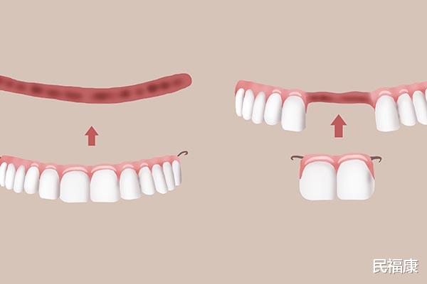 牙齿|牙齿掉落不知道怎么补？几种方法如何选择？一篇文章说清楚