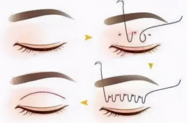 养生|不动刀子,也可以变得很美,盘点那些超给力的医美微整!