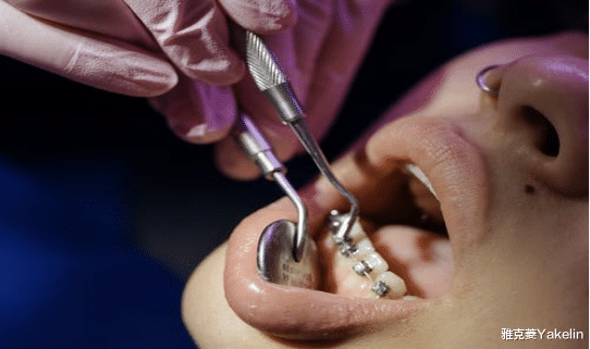 雅克菱Yakelin|牙套又又又磨嘴了!怎么解决啊?