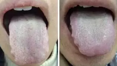 山楂|舌苔辨识9种中医体质，有配图！