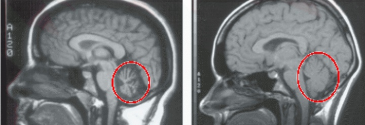 红枣|小脑萎缩前期的头晕不重视，会带来大问题