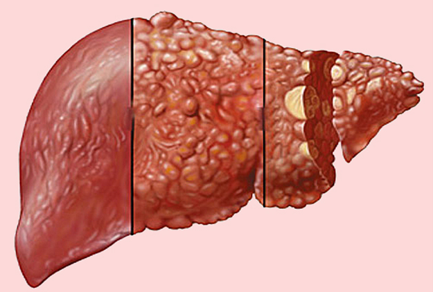 肝脏|体内有癌，肩先知！肩膀若出现这1种异常，或是癌细胞正在“苏醒”