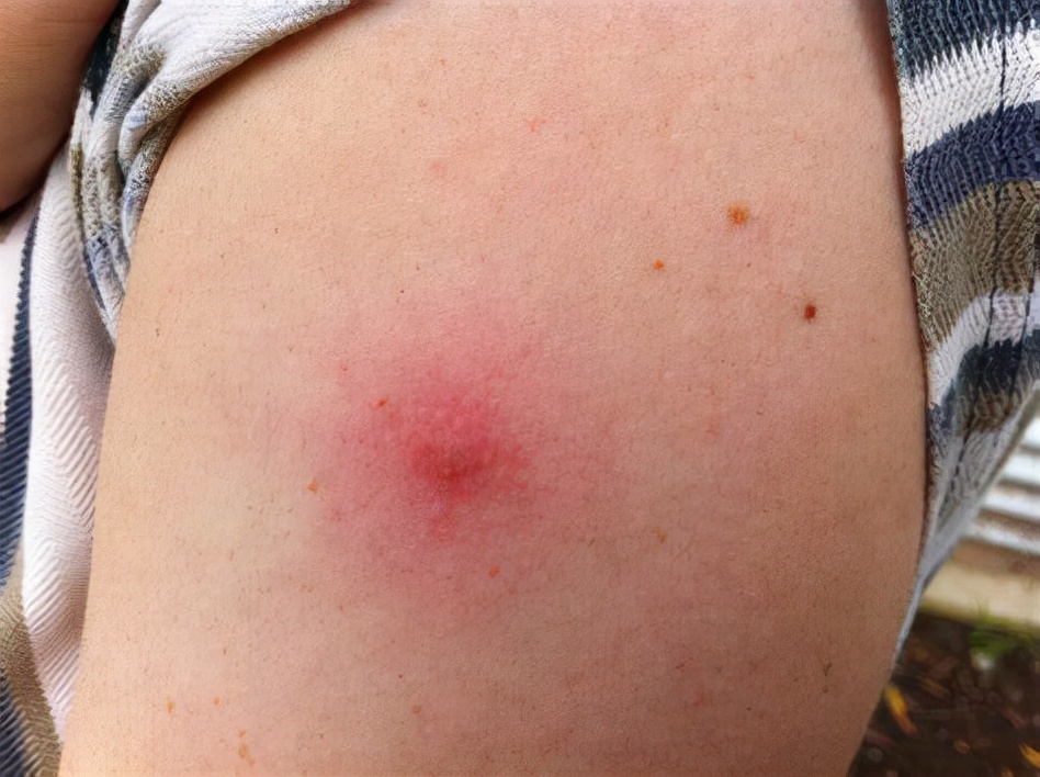 医生|“神药”阿司匹林绝对安全吗？饭前吃还是饭后吃？医生给出建议