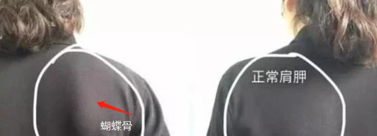 迪丽热巴|迪丽热巴的“蝴蝶骨”又出圈了，如此美背居然是一种病？