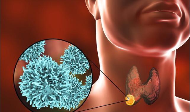 阿胶|全民加碘26年，中国甲状腺癌人数不断增加，碘盐要不要继续吃？