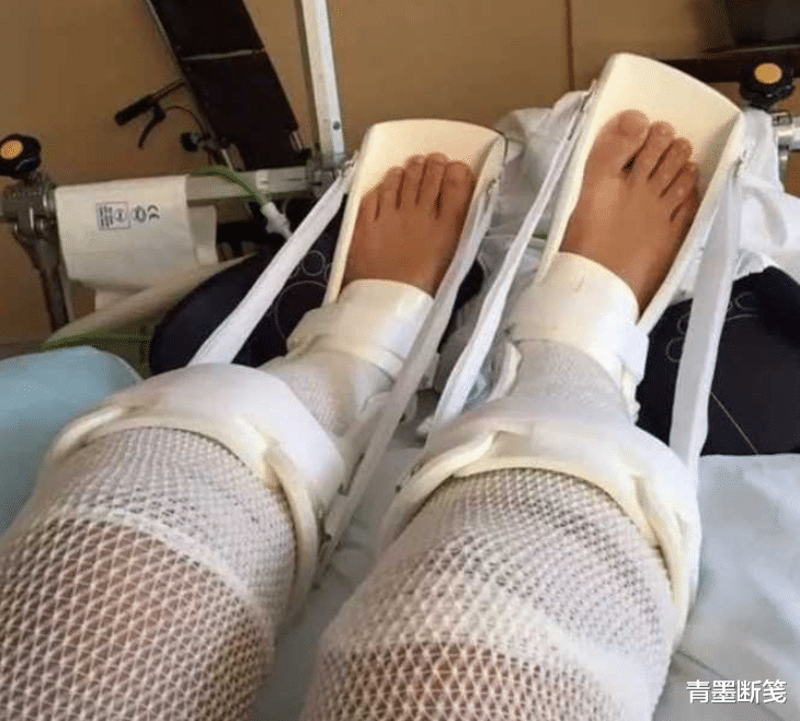 7年前,李亚诺花16万锯断骨头,只为长高7厘米,手术后怎样了?