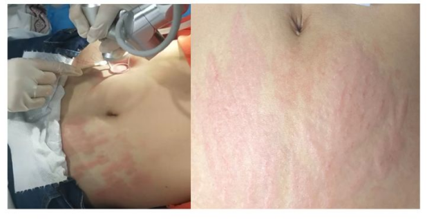 夏小可育儿|孕期防纹四部曲,准妈妈都“达标”,妊娠纹也会远离你的!