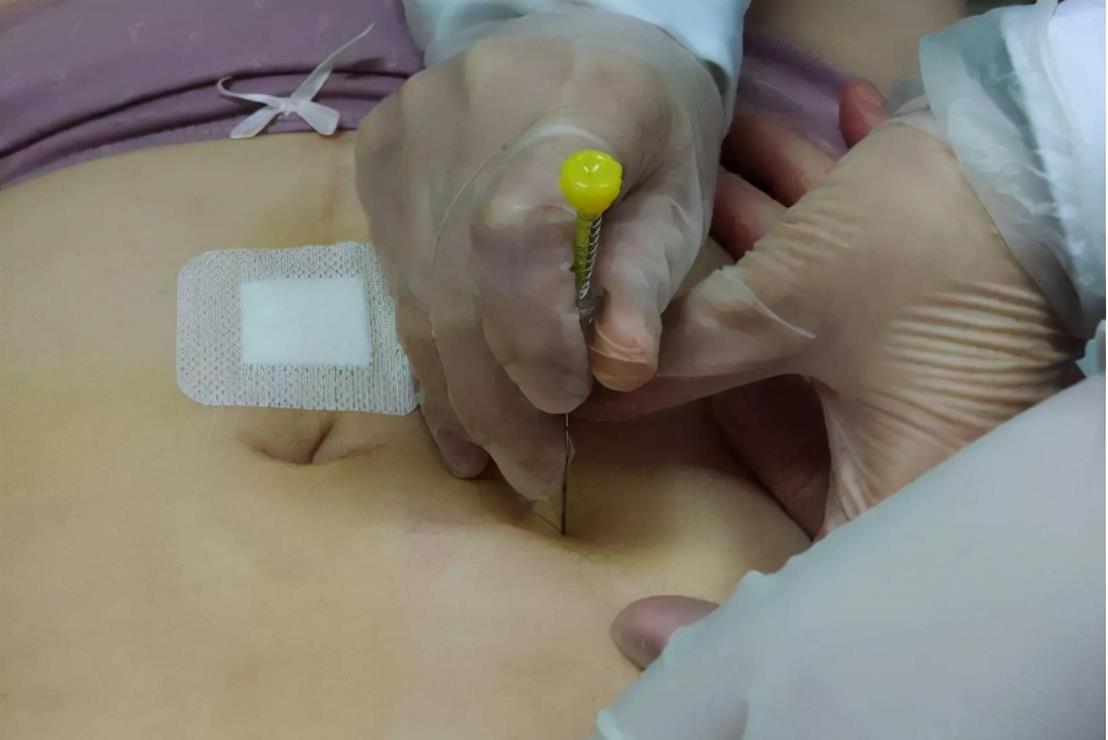 痔疮|降脂必看，得了高血脂症和动脉粥样硬化，该怎么办？