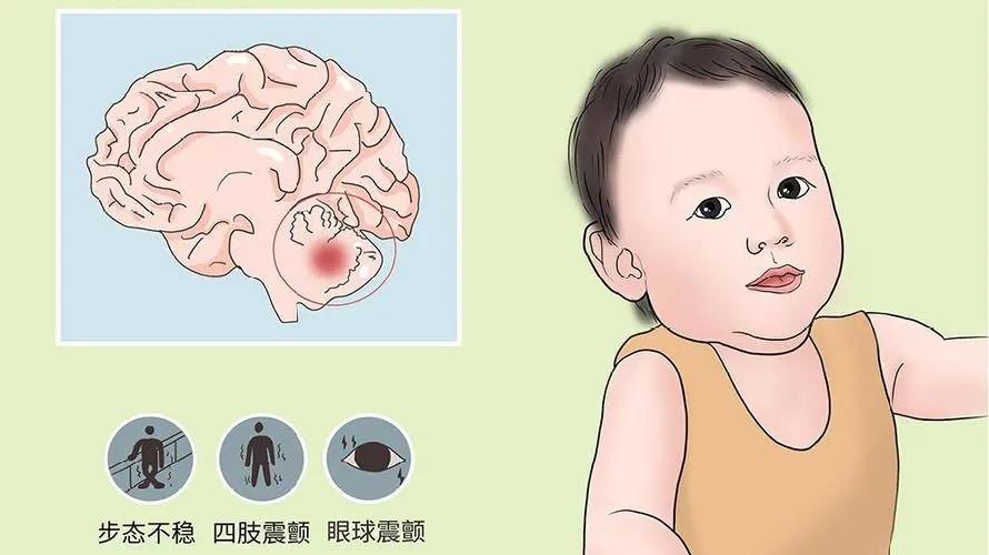 天秀孤儿|小脑萎缩共济失调是什么？
