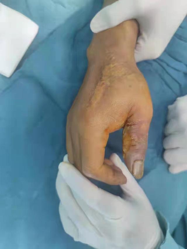 松鼠|堵漏神器危险性极大 米粒小孔打废工人手掌