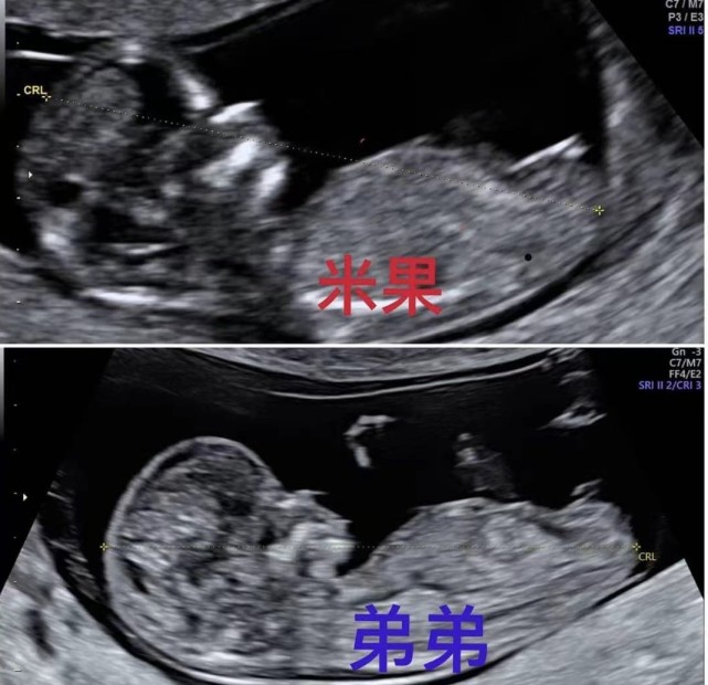 羅志祥43歲經紀人小霜宣佈懷二胎，仍是試管嬰兒，孩子父親不詳-圖6