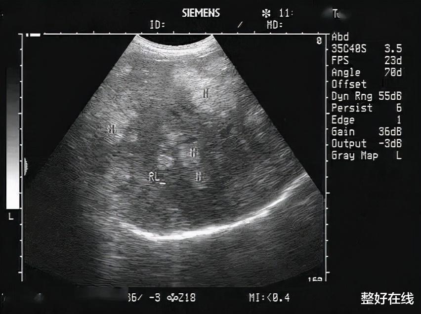 肝硬化|肝硬化患者在B超中的特征有哪些？专家直言：导致肝硬化成因有3种