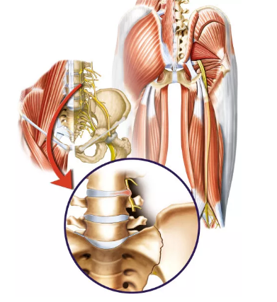 神经损伤|这些症状很可能是腰椎管狭窄症，避免马尾神经损伤，早诊断早治疗!