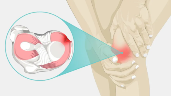 亚健康调理廖老师|如何保护你的半月板