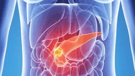 胰腺癌|以为是胃病,却发现是胰腺癌?身体的4个信号,别忽视!