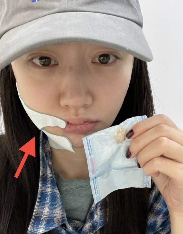 景甜|景甜素颜曝光认不出，怼脸自拍双眼皮疤痕明显，曾大方承认整容