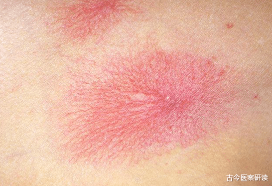 心脏|这个部位长“小红点”,提示肝脏可能出现问题了,建议早查肝ct