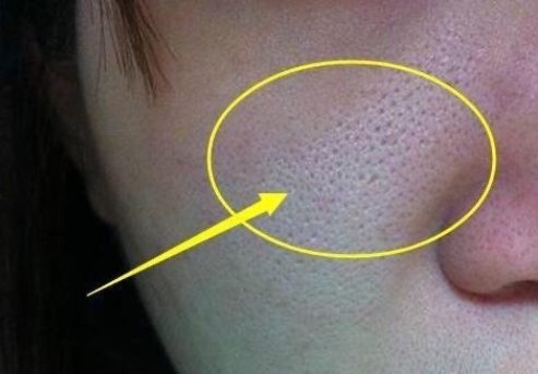 口红|脸上长粉刺、导致毛孔粗大？改掉这3个坏习惯，皮肤越来越好