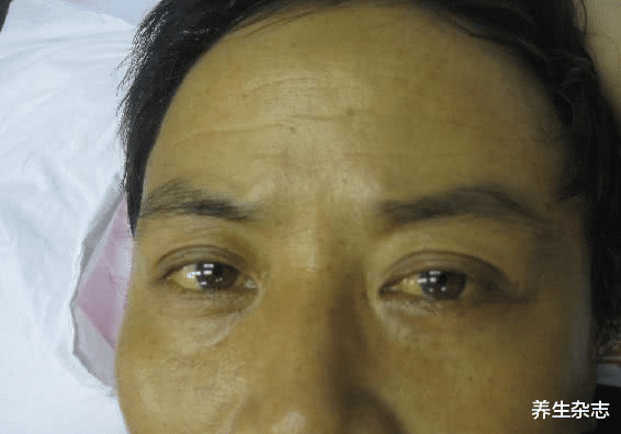 养生杂志 脸上若有4种迹象，多半是肝不好了，哪怕占一个，也要尽早检查