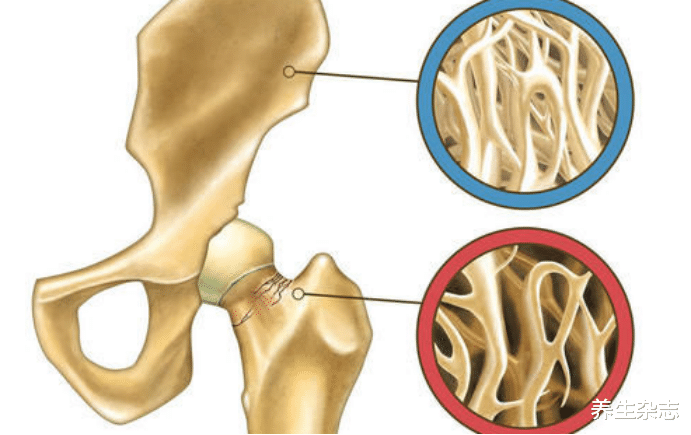 骨质疏松|多家医院联合叫停:吃一口等于熬夜七天,再不扔掉,骨骼迟早烂如“蜂窝”