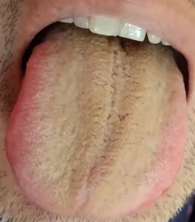 失眠|舌象分析：短气，胆小 失眠