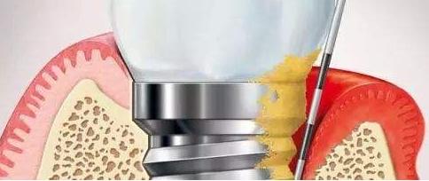 并发症|种植牙在使用期间可能会出现的常见问题盘点