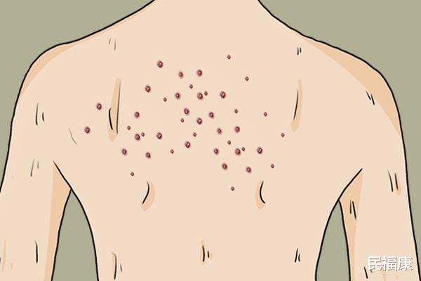 毛囊炎|毛囊炎和青春痘有什么区别？教你如何预防