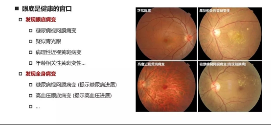全球医 爱眼底|为什么要进行眼底检查,眼底检查能查出什么?