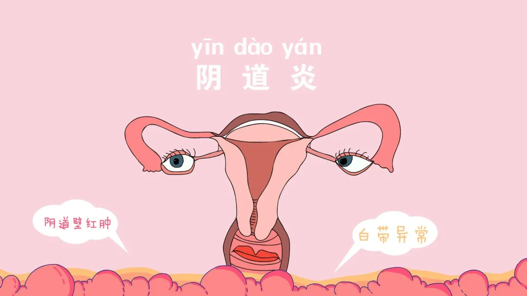 小智健康助手|别羞羞，有阴道炎要趁早治！