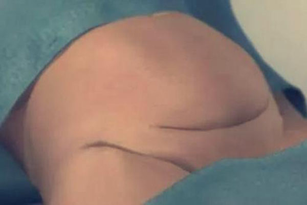 怀孕妈妈知识宝典|八张图详解剖腹产手术全过程 看完真的好心疼女人