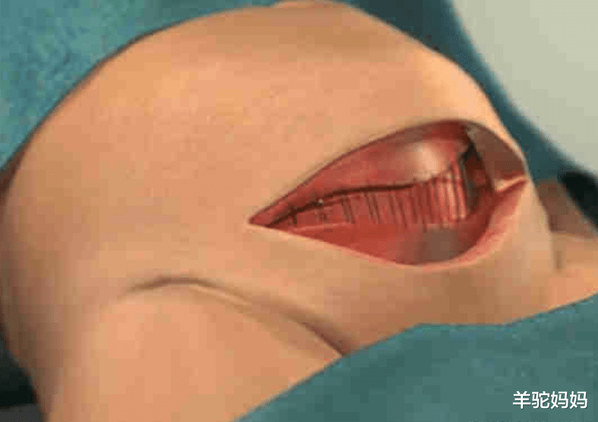 羊驼妈妈|剖腹产真有想得那么简单吗？看看手术所需的“工具”，真为母则刚